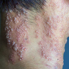 Avaderma Skin & Hair Clinic - Seborrheic Dermatitis